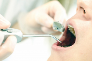 虫歯や歯周病のリスク評価