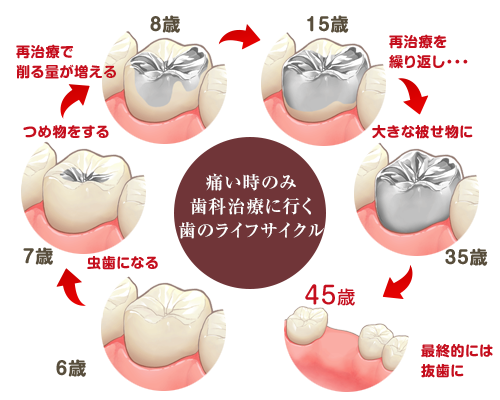 歯を失うサイクル